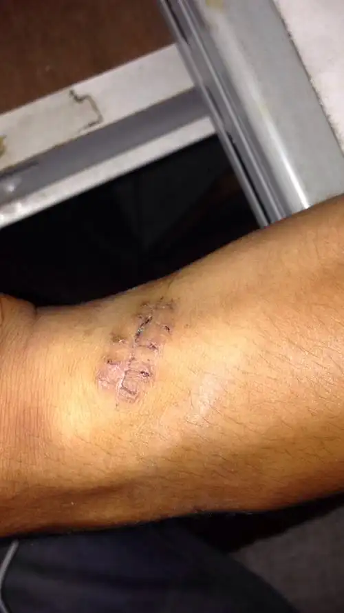 手臂缝针拆线拆了两天线可以不包扎了吗