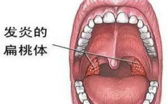 急性喉炎是咳嗽得比较频繁吗(咽喉肿痛有这个症状可能是得了传染病)(2