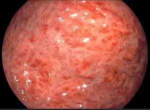 老年人慢性胃炎