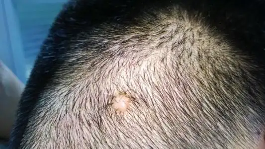 怎样才能去掉头上的头皮宵