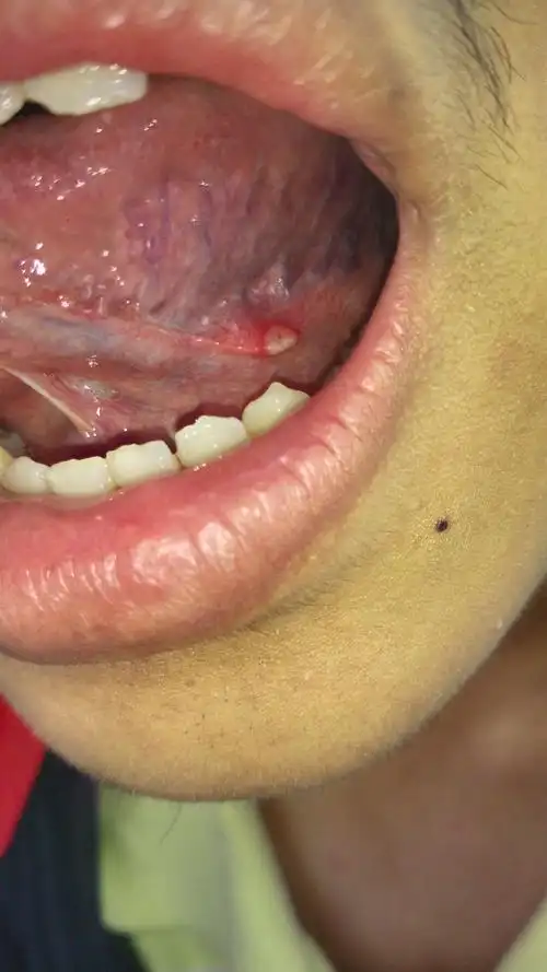 舌头下面起了一个泡,好痛,请问这是怎么了?怎么解决?