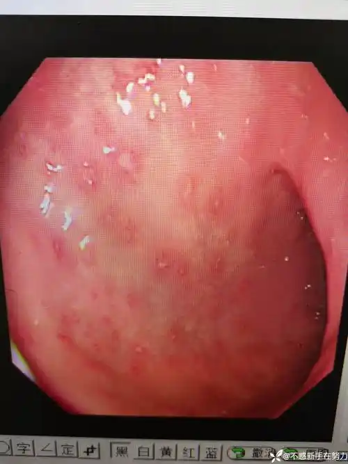 胃体点状红肿糜烂