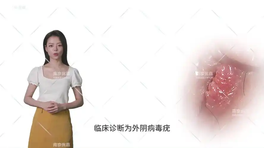 女性鸡冠状尖锐湿疣症状图片