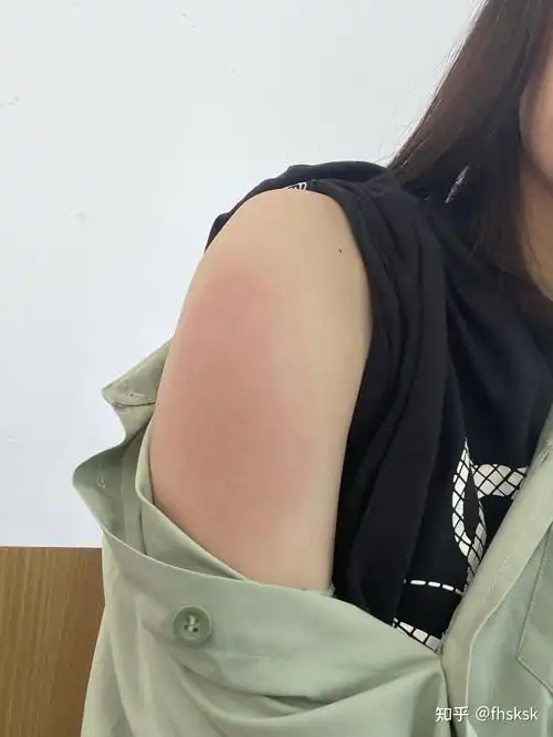 打预防针胳膊红肿了怎么办 打预防针胳膊红肿了怎么办还疼