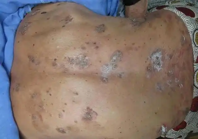 癌症"光临"皮肤有5种症状,建议尽早做检查,提前发现潜在肿瘤