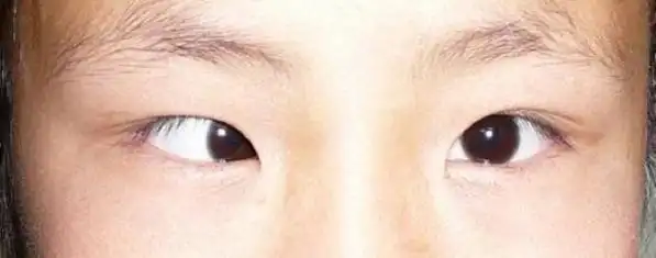 什么是斜视?有什么危害?