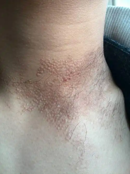 希望好心医生能帮我看看这个,我脖子上的皮肤成这样了,13岁以前仅仅是