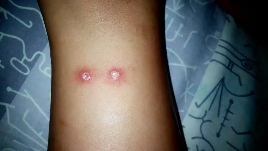 长了两个红包疙瘩,破了出水,有化脓的迹象,不知道是被什么虫子咬的,请