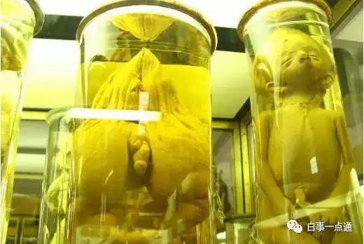 症馆内有许多畸形婴儿的标本,而像这样并未泡在福尔马林的却少之又少