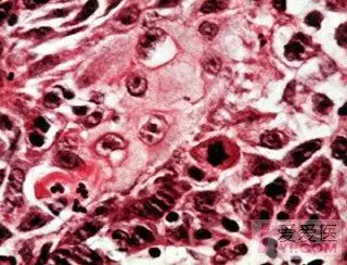 【资源】几例口腔鳞癌图片