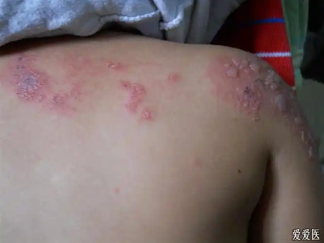 小儿带状疱疹 - 皮肤及性传播疾病讨论版 - 爱爱医医学论坛