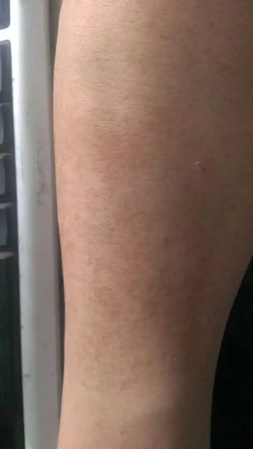 我想问问我右胳膊上有暗灰色点状的色斑怎么才能去除.