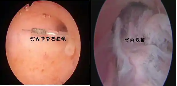 即看即走云浮市人民医院妇科开展门诊宫腔镜诊疗