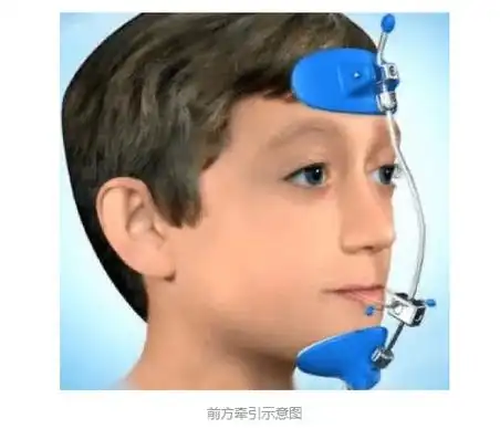 替牙期反颌双期矫治 年龄:10岁,矫治器:前方牵引 (10个月) 隐适美隐形