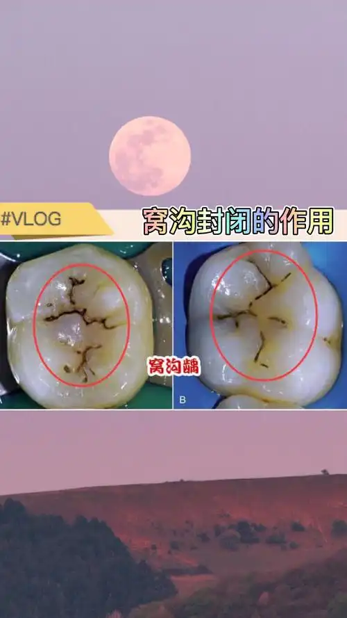 学校组织的窝沟封闭是什么?