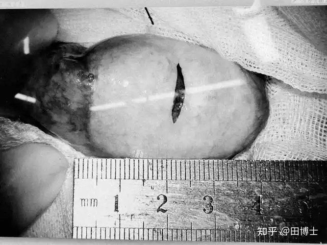 孩子爸爸于先生田汝辉博士睾丸没有血流半年多了一瓢羹田医生,8