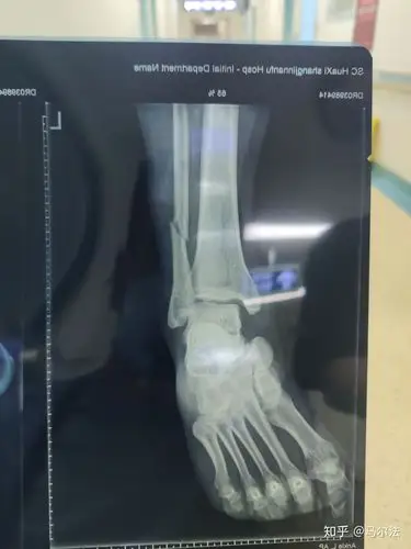 拍片前,满脑子都祈祷不是骨折,只是崴脚或者韧带受伤.