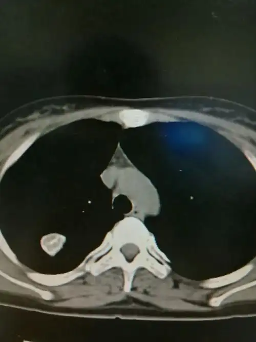 其它 结核球的相关征象及诊断 写美篇右肺上叶见类圆形混杂密度影,内