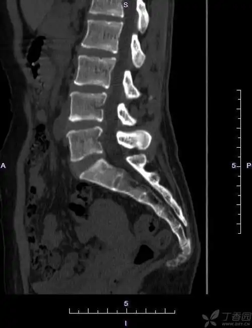 【读片】骶尾椎ct [病例帖]