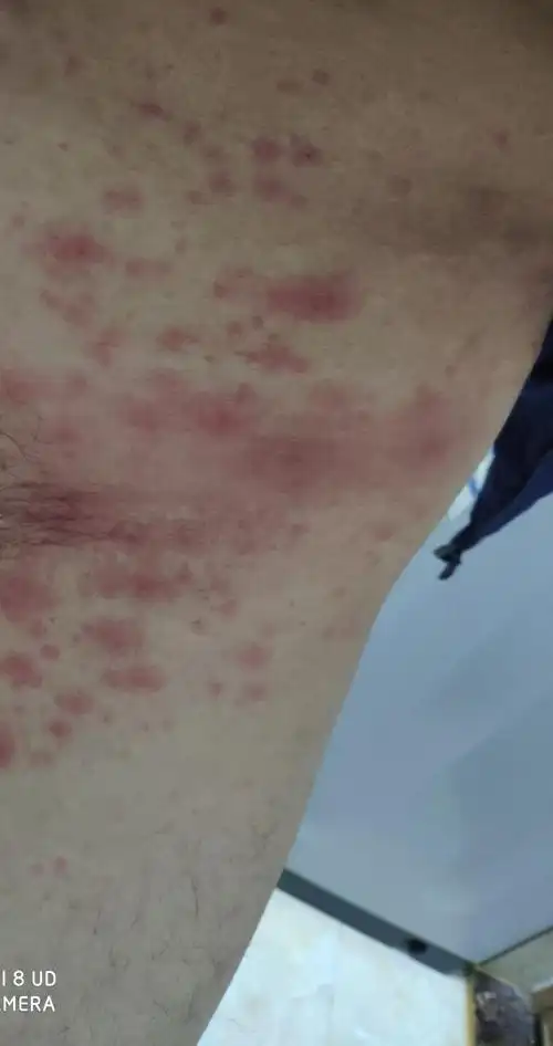 重新发贴-吧医给看看是不是过敏(荨麻疹or湿疹)-痒死了