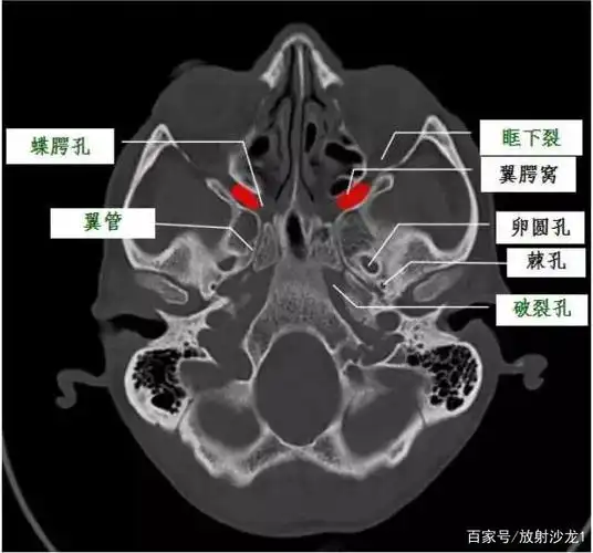 翼腭窝的ct影像解剖