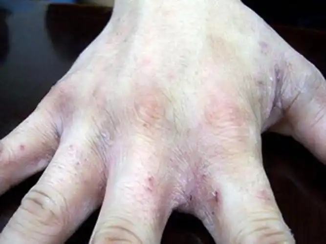 孕妇疥疮初期皮肤症状图片