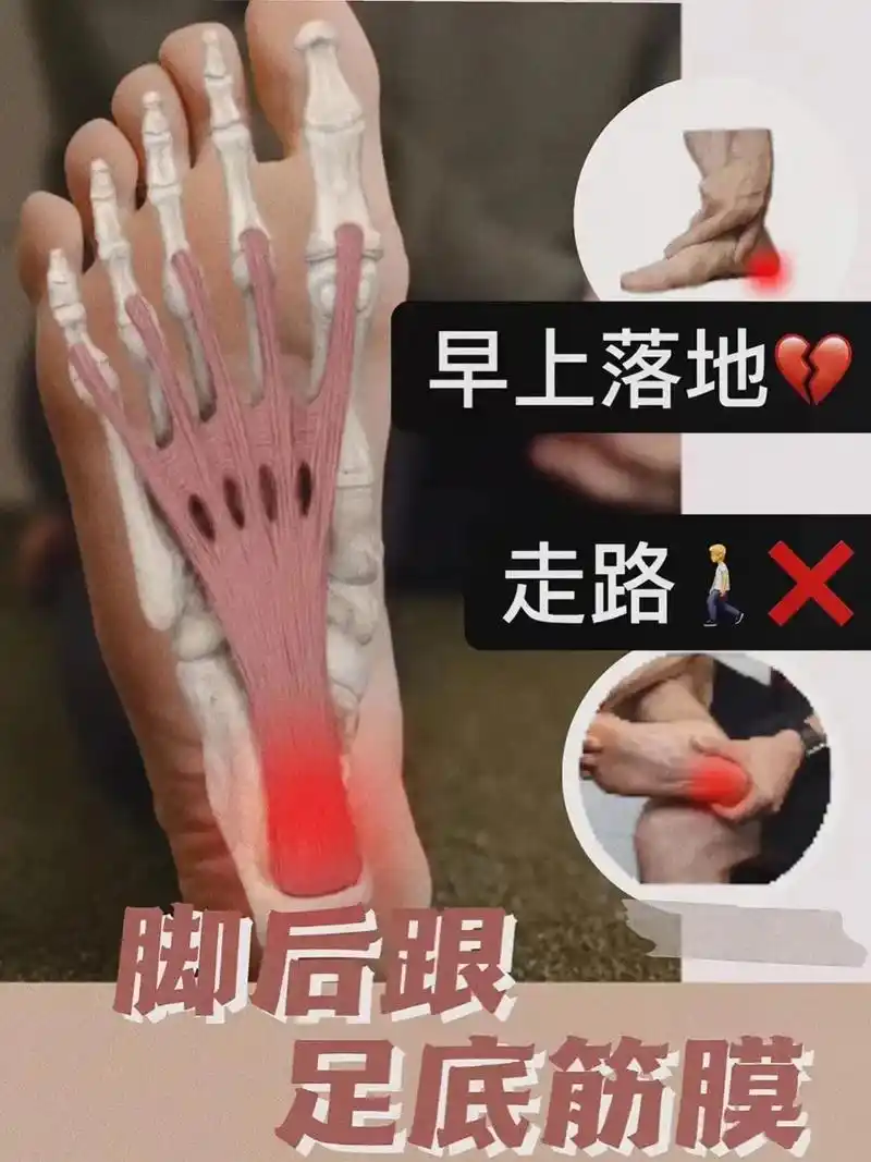 足底筋膜炎.#dou来涨健康知识 #分享健康#健康科普 - 抖音