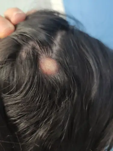 表皮样囊肿(皮脂腺囊肿) - 好大夫在线