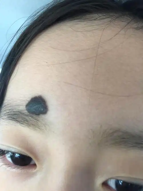 面部色素痣