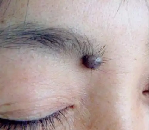 什么样的色素痣需要我们加以警惕? - 好大夫在线