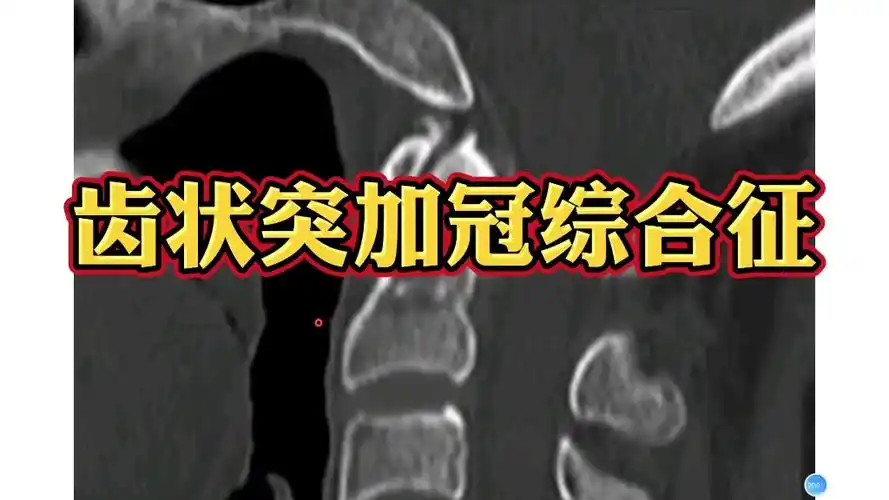齿状突加冠综合征ct如何诊断?放射科医生讲解!