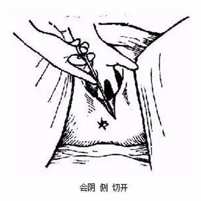 生孩子侧切缝线伤口的护理知多少