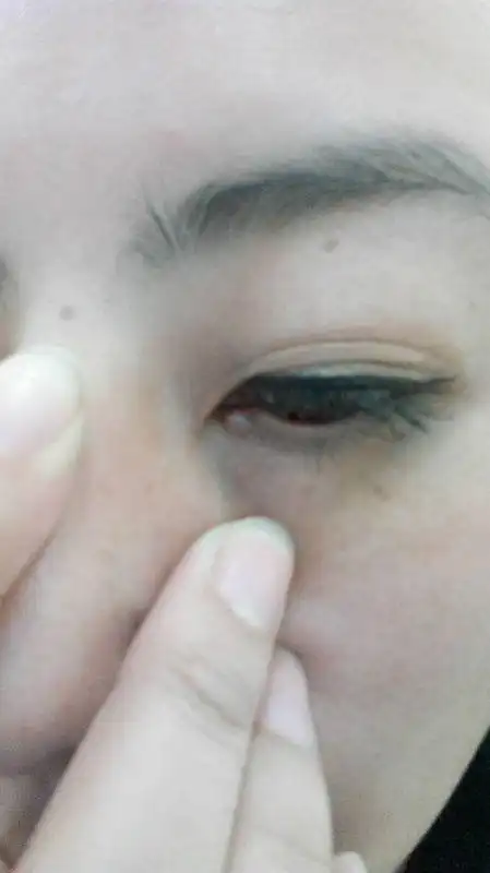 眼角长了个囊肿 只能手术治疗吗?