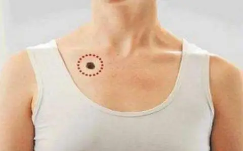 胸上有痣代表什么 七个女人胸前不同位置长痣代表的含义
