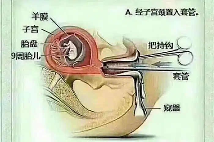 刮宫有多疼术后要休息一周吗