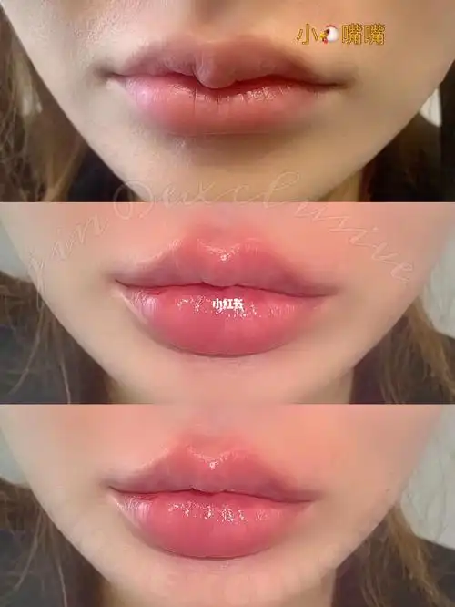 7373唇珠修复 术前的唇珠太诡异啦97 同时调整了不对称 嘴角