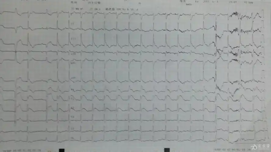 房室分离 - 心电图脑电图专业讨论版 - 爱爱医医学论坛