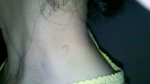 脂肪瘤图片图 (26)