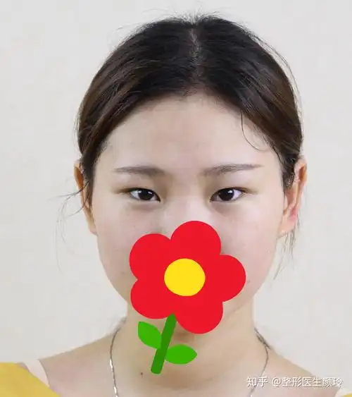 吊眼单眼皮:不同程度的吊眼需要不一样的处理(1)