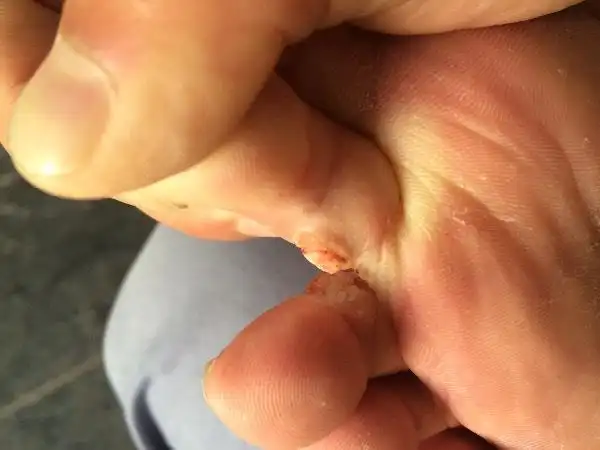 脚趾缝上长了个像鸡眼一样的东西,不痛不痒一直没在意,用刀一刮就出