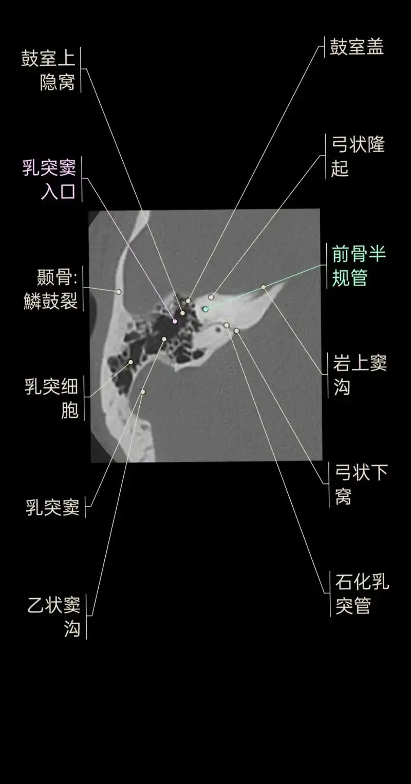 颞骨乳突高分辨ct图解.#干货分享 #医学影像 #放射科 # - 抖音