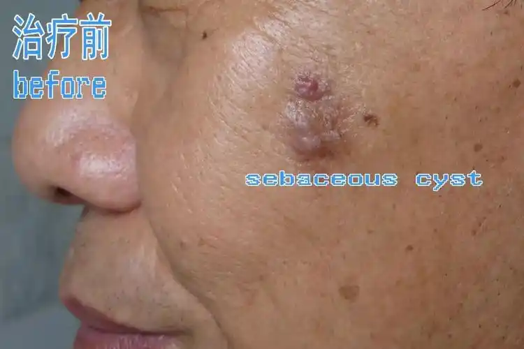 脸上的粉瘤不用开刀也能去除