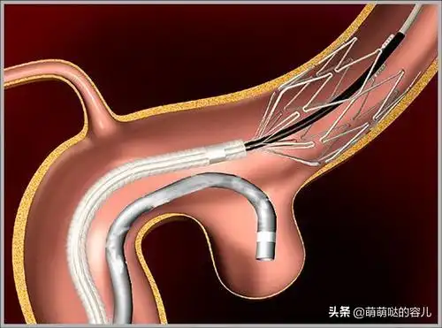脑血管支架手术需要多少钱(让我们正视脑血管植入手术) - 价格百科