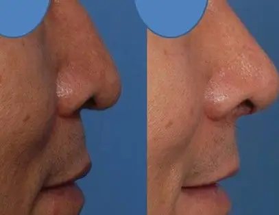 鹰钩鼻畸形如何矫正_鹰钩鼻整形——青岛华韩整形美容医院