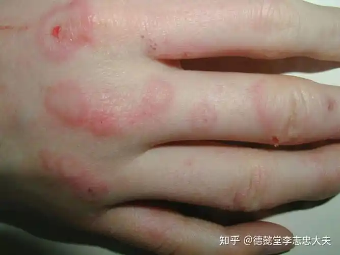 这个季节一定要警惕多形性红斑