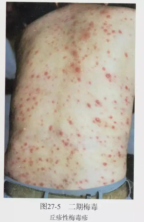 梅毒患者的悲剧,美总统致歉,极不道德的塔斯基吉实验|淋病|螺旋体