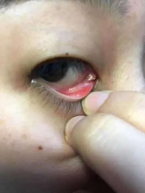 眼睛里的这个从高中就有了,越长越大,但是长得慢,平时也没感觉,有问题