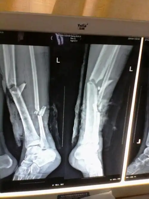 轻微骨折赔2万5 轻微骨折保险能赔多少钱