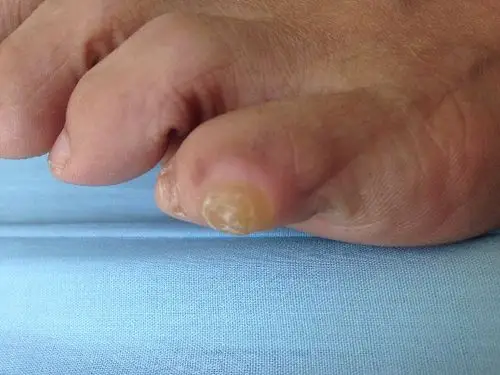 小脚趾头外侧长了一个硬邦邦的像老茧,有时候还疼!用剪子剪掉后自己