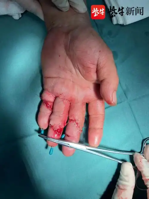 工作不慎切断三根手指常州二院奋战5小时针尖芭蕾创奇迹